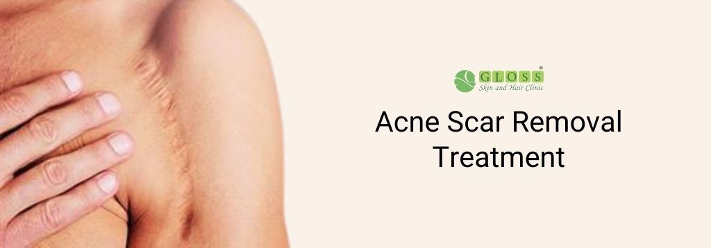 acne-scar-removal-treatment-in-mumbai-gloss-clinic.jpg
