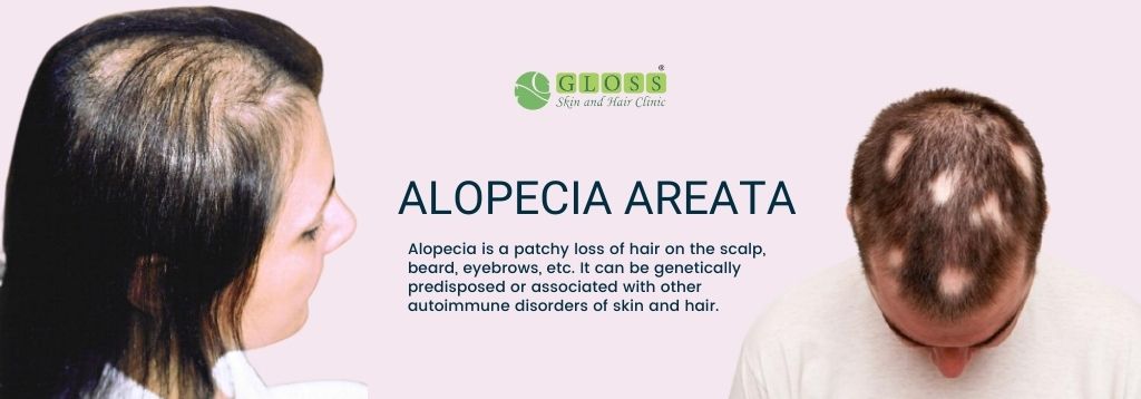 Alopecia-Areata-treatment-in-mumbai-gloss-clinic