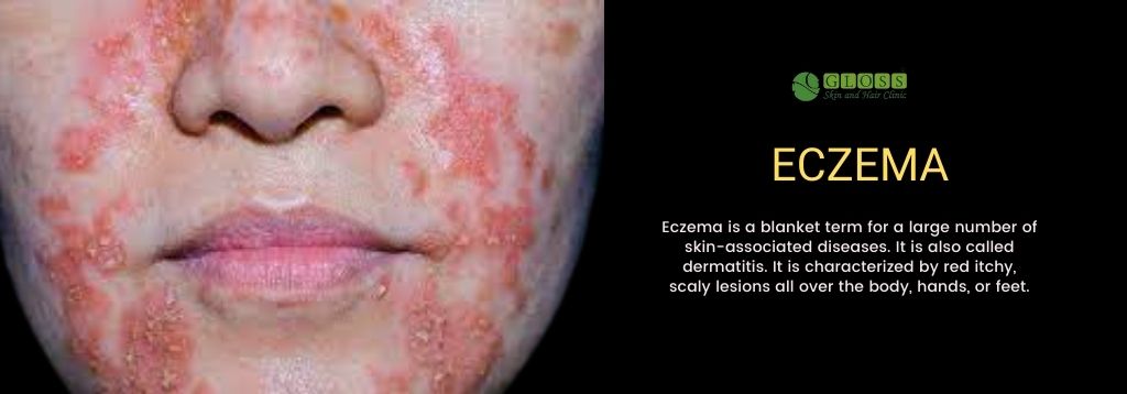 eczema-treatment-in-mumbai-gloss-clinic