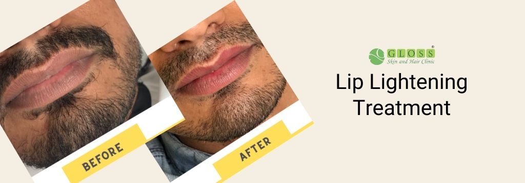 lip-lightening-treatment-in-mumbai-gloss-clinic.jpg