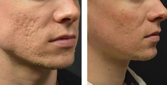 Microneedling for Acne Scars - Acne Scar Treatment in Andheri West Mumbai