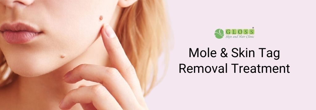 mole-skin-tag-removal-treatment-in-mumbai-gloss-clinic.jpg