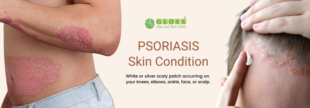 psoriasis-treatment-in-mumbai-gloss-clinic