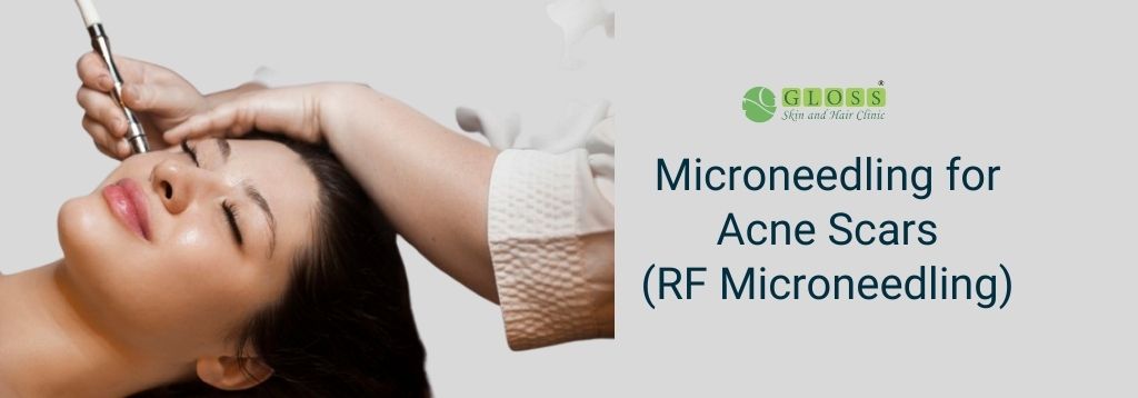 rf-microneedling-treatment-in-mumbai-gloss-clinic.jpg