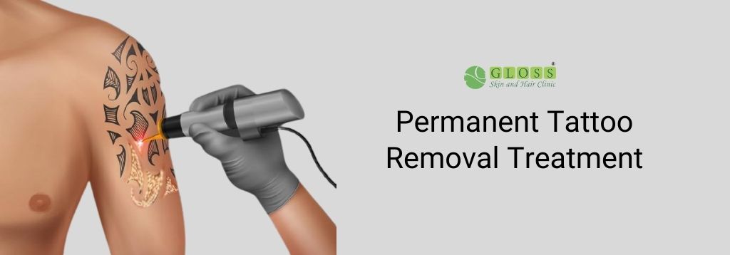 Skin and You  Painless Tattoo Removal